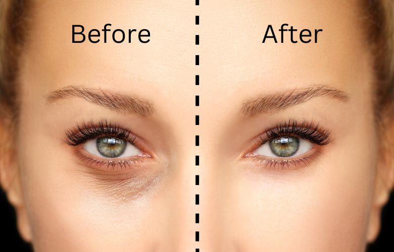 What Is Blepharoplasty?
